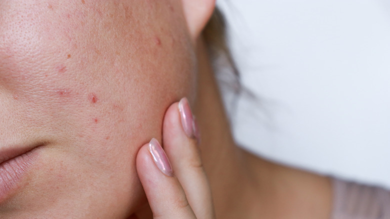 close up of woman's cheek with acne