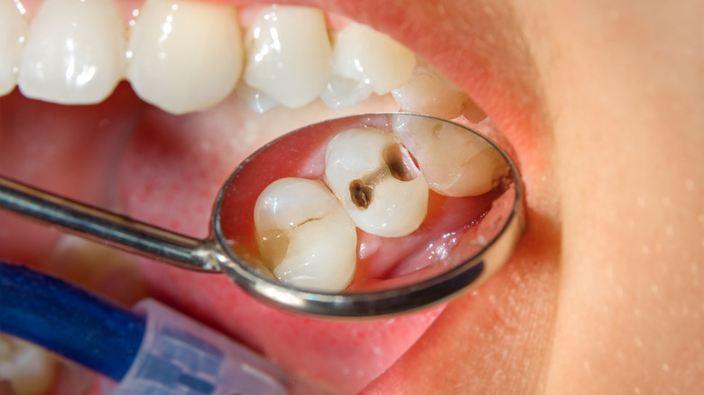 Dental Fillings