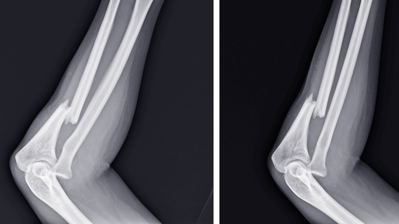 broken forearm x-ray