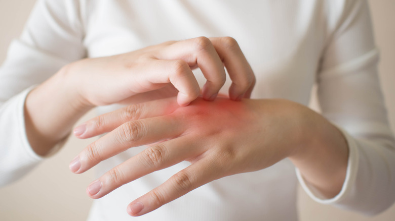 Hand scratching red irritated skin on top of other hand