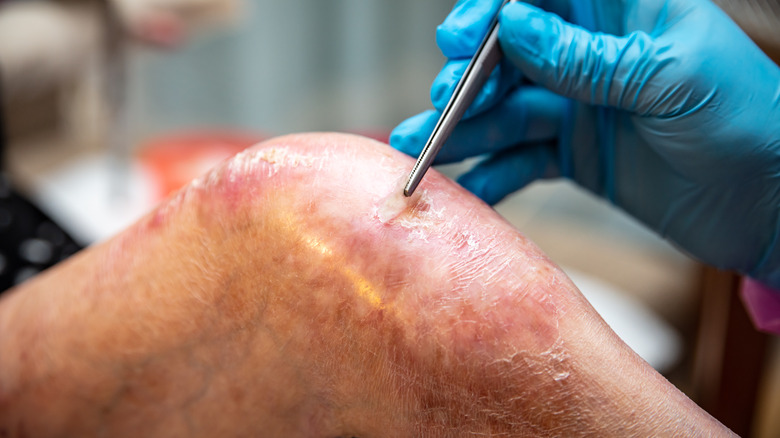 doctor removing epidermolysis bullosa scabs