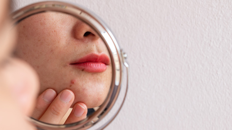 woman looking at her acne