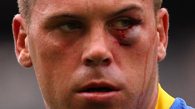 Rugby player with black eye 