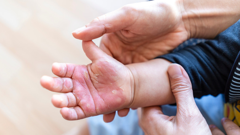 child with burned hand